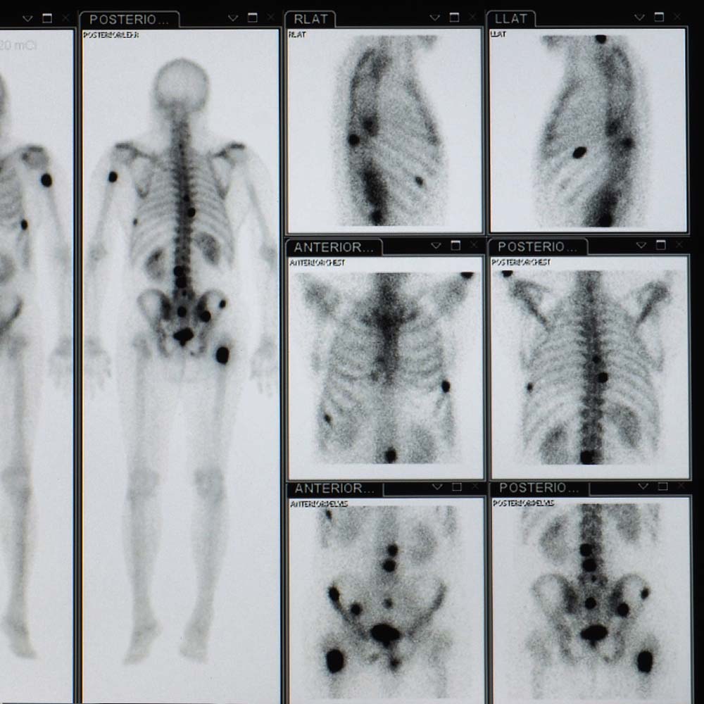 Bone scan image of a patient showing multiple bone and spine metastasis